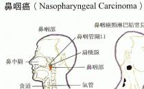 鼻咽癌的早期癥狀有哪些？