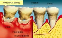 牙周炎會(huì)誘發(fā)類(lèi)風(fēng)濕關(guān)節(jié)炎