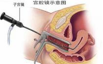 正確使用宮腔鏡 患有哪些疾病不可用宮腔鏡