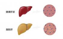 脂肪肝的治療方法 應(yīng)酬男應(yīng)該看看
