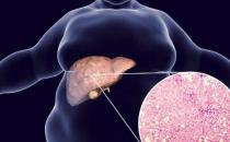 脂肪肝是把軟刀子 即使不胖肝臟可能早已被脂肪包圍