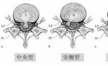 患上腰椎病，一定不能拖！內(nèi)鏡微創(chuàng)手術(shù)，一步治好它！